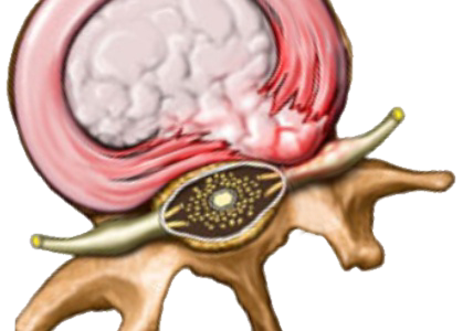 hernia disku