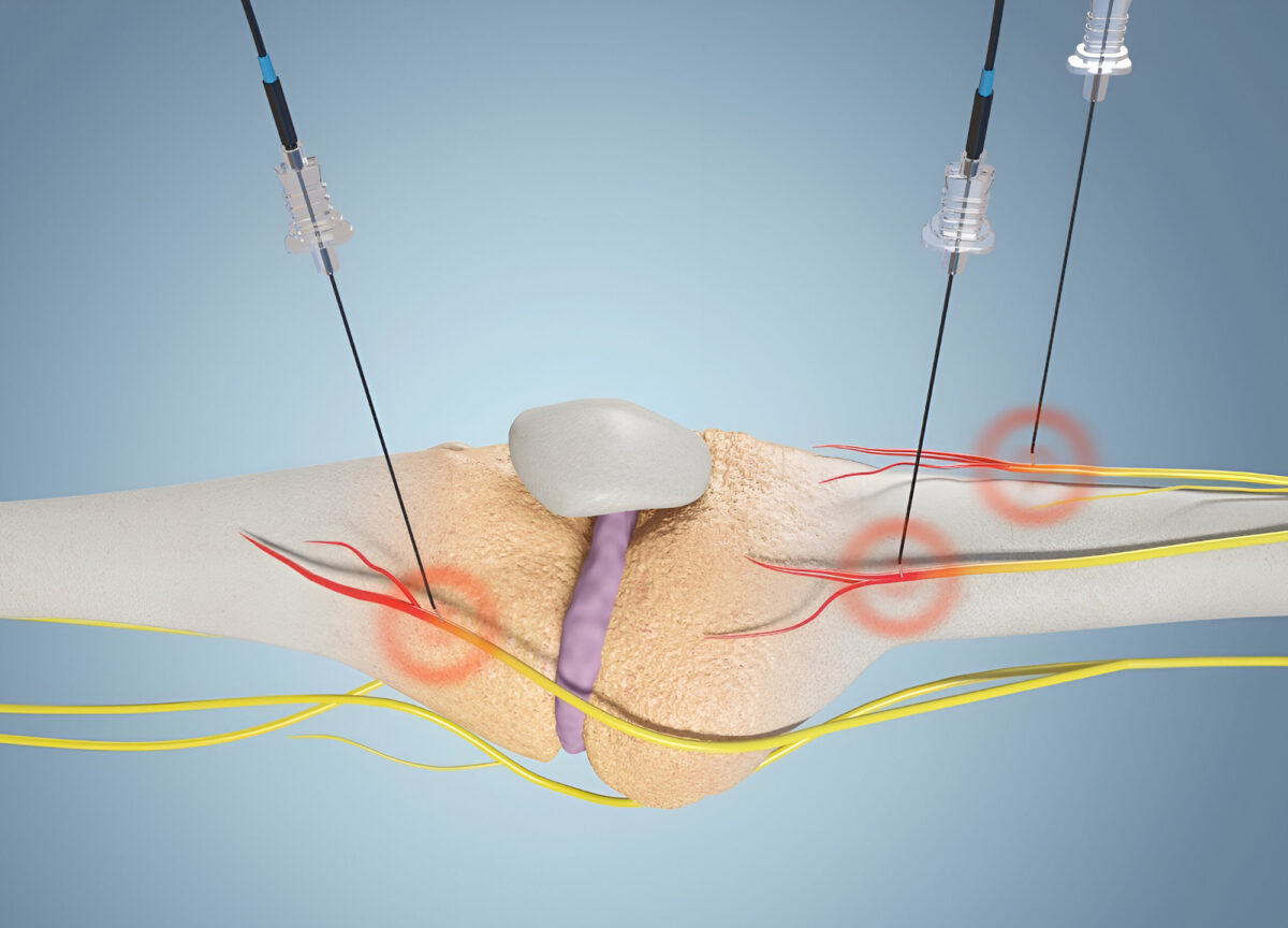 Duálna rádiofrekvenčná liečba bolesti kolena