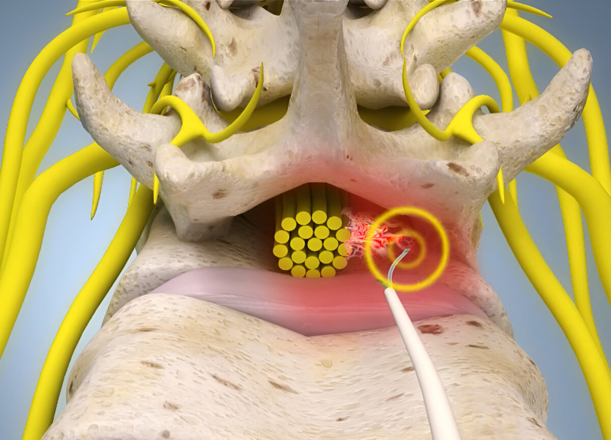 Epiduroskopicky asistovaná adheziolýza v epidurálnom priestore (epiduroskopia)
