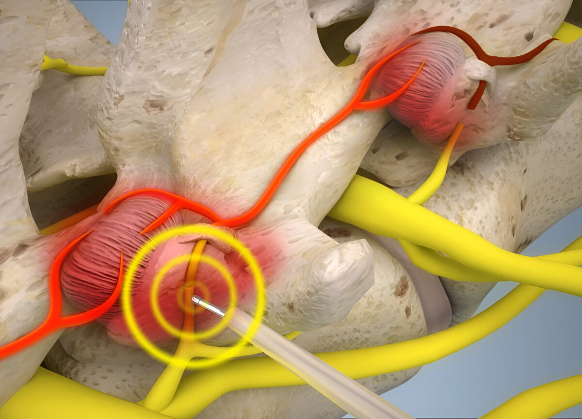 Perkutánna endoskopická denervácia medzistavcových kĺbov
